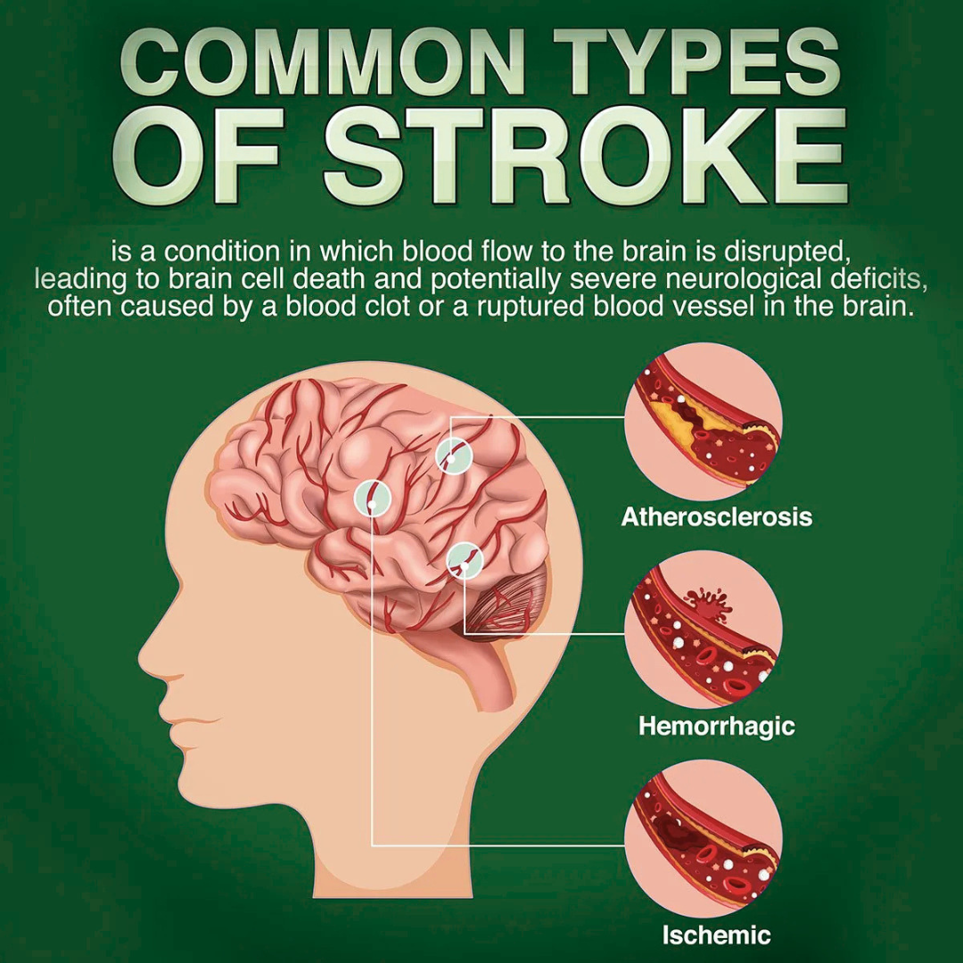 Stroke-Attack-Is-Dangedrous.png